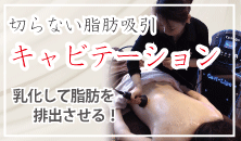 キャビテーションの施術 キャビテーションの施術